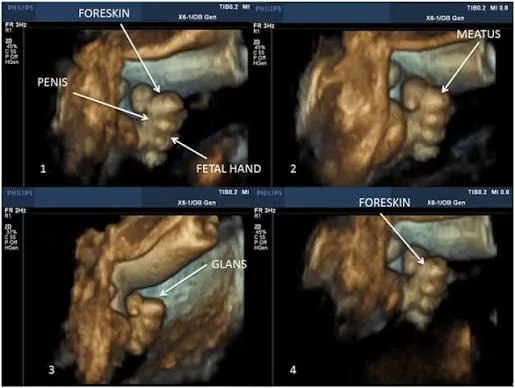 Four labeled 3D ultrasound images of a male fetus, identifying the penis, glans, foreskin, and a fetal hand.
