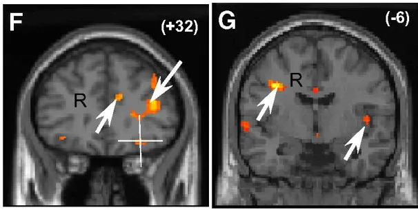 Brain scans of people recently rejected in love, showing elevated activity in the anterior cingulate and insular cortex, regions associated with physical pain.