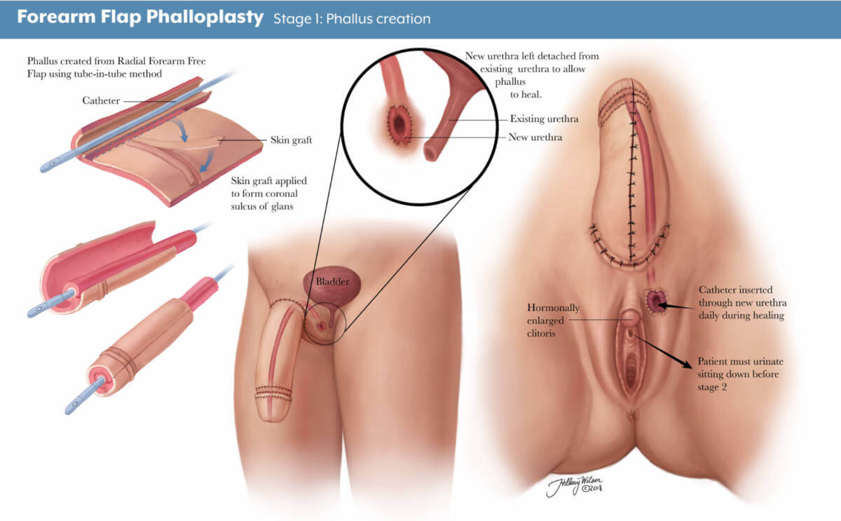 A medical illustration of forearm-flap phalloplasty, a genital surgery that constructs a penis for a trans man.