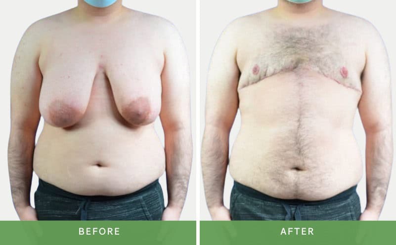 A before-and-after photograph of a trans man's chest following masculinizing 'top' surgery.