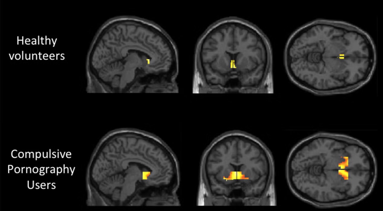 Two rows of brain MRI scans with colored activation overlays comparing healthy volunteers and compulsive pornography users.