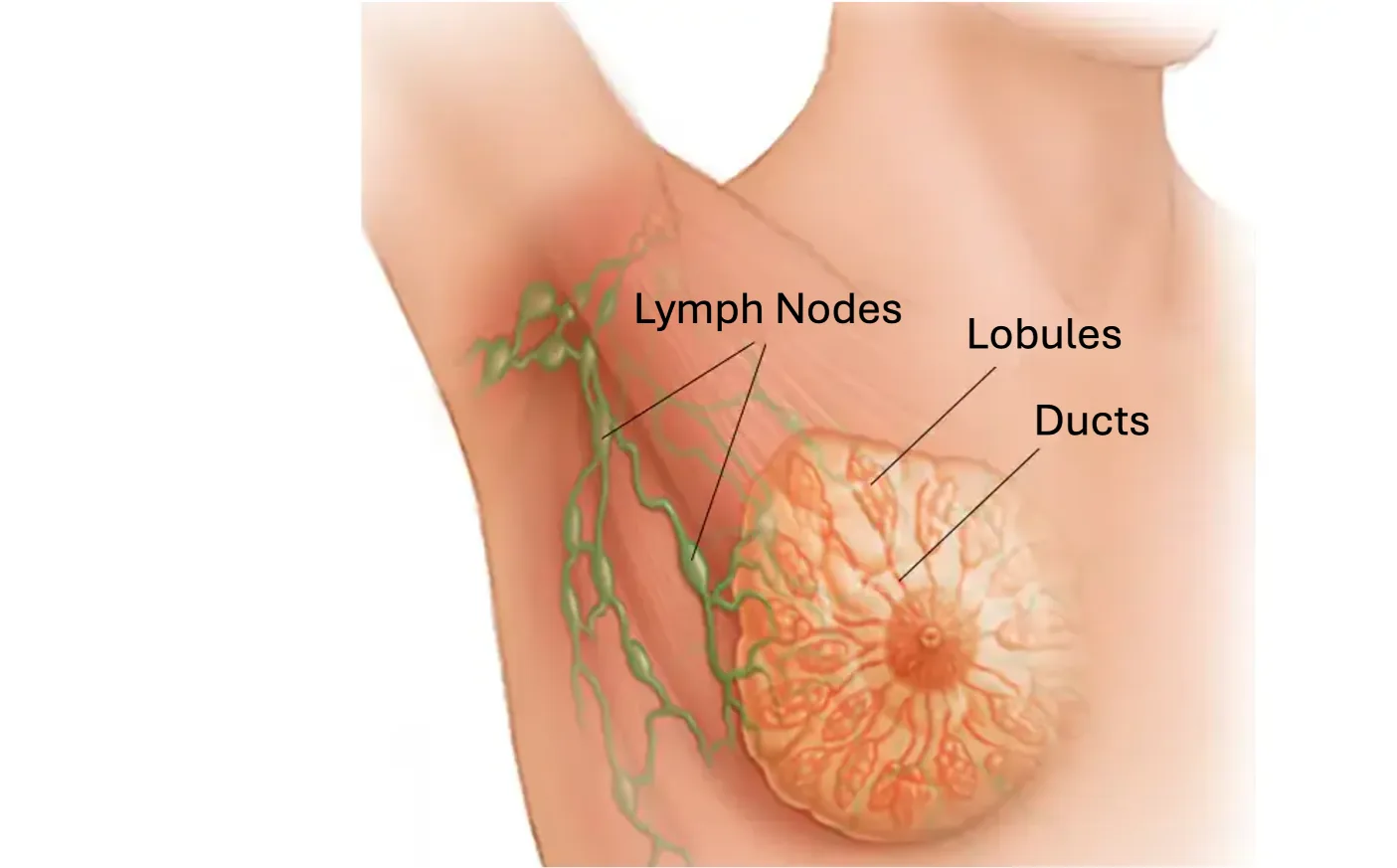 A diagram of the breast showing the most common locations where breast cancer develops: the ducts, lobules, and lymph nodes, extending into the armpit area.