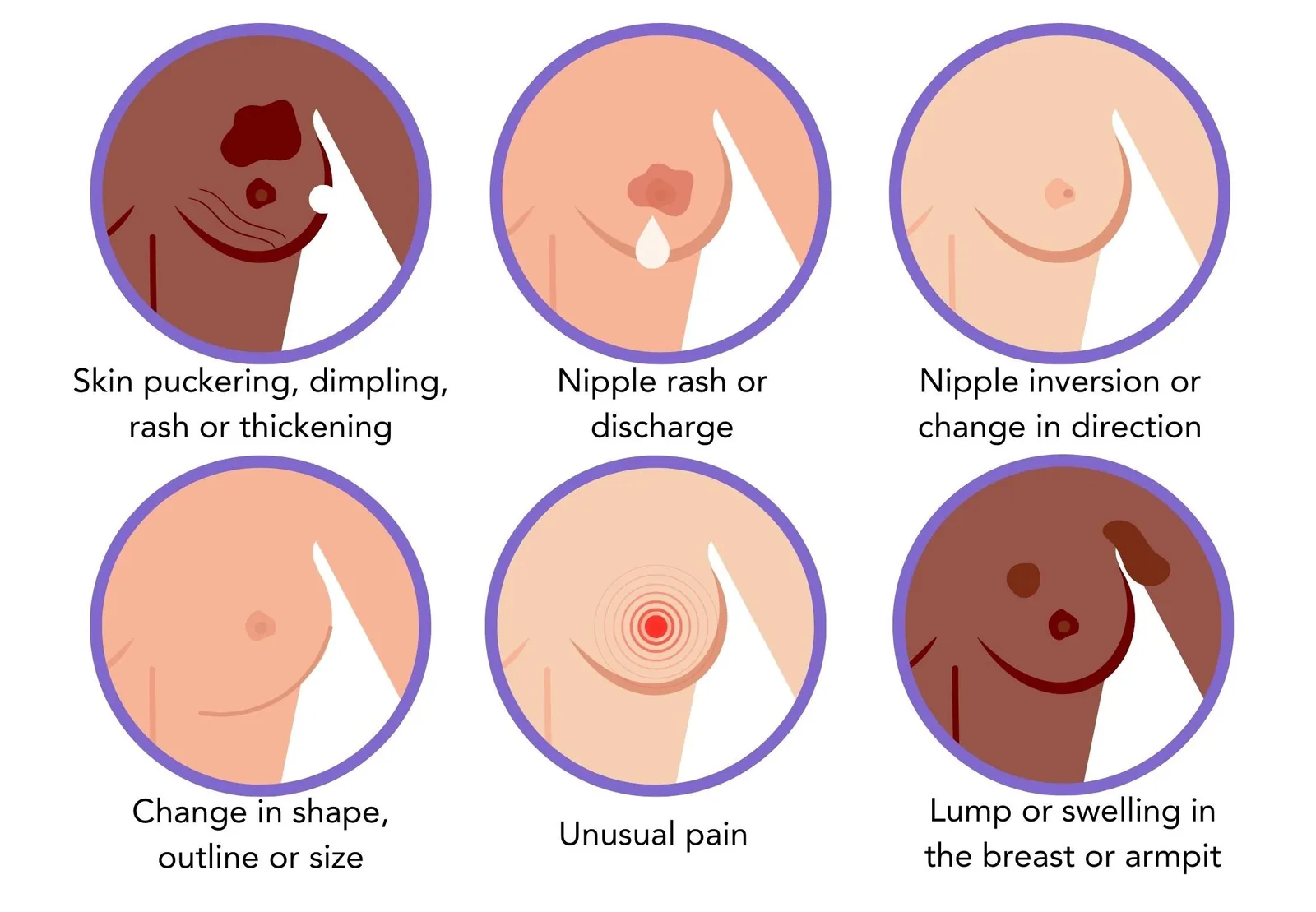 An infographic showing common signs of breast cancer, including lumps, changes in skin texture, nipple discharge, and changes in breast shape.