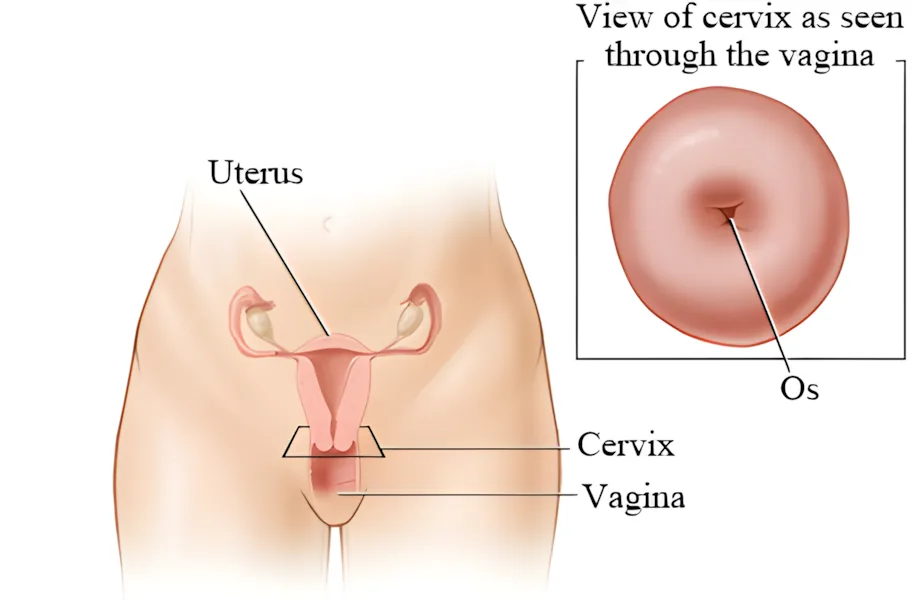 A photograph of the cervical os as seen through the vagina, showing the small circular opening at the center of the cervix.