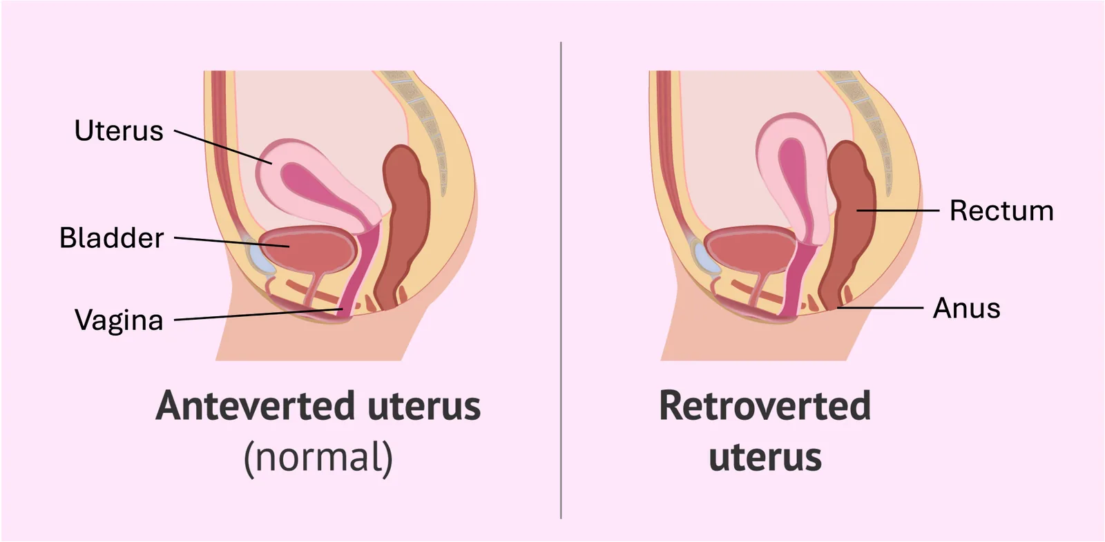 A comparison diagram showing a normal forward-tilting uterus on the left and a retroverted (backward-tilting) uterus on the right.