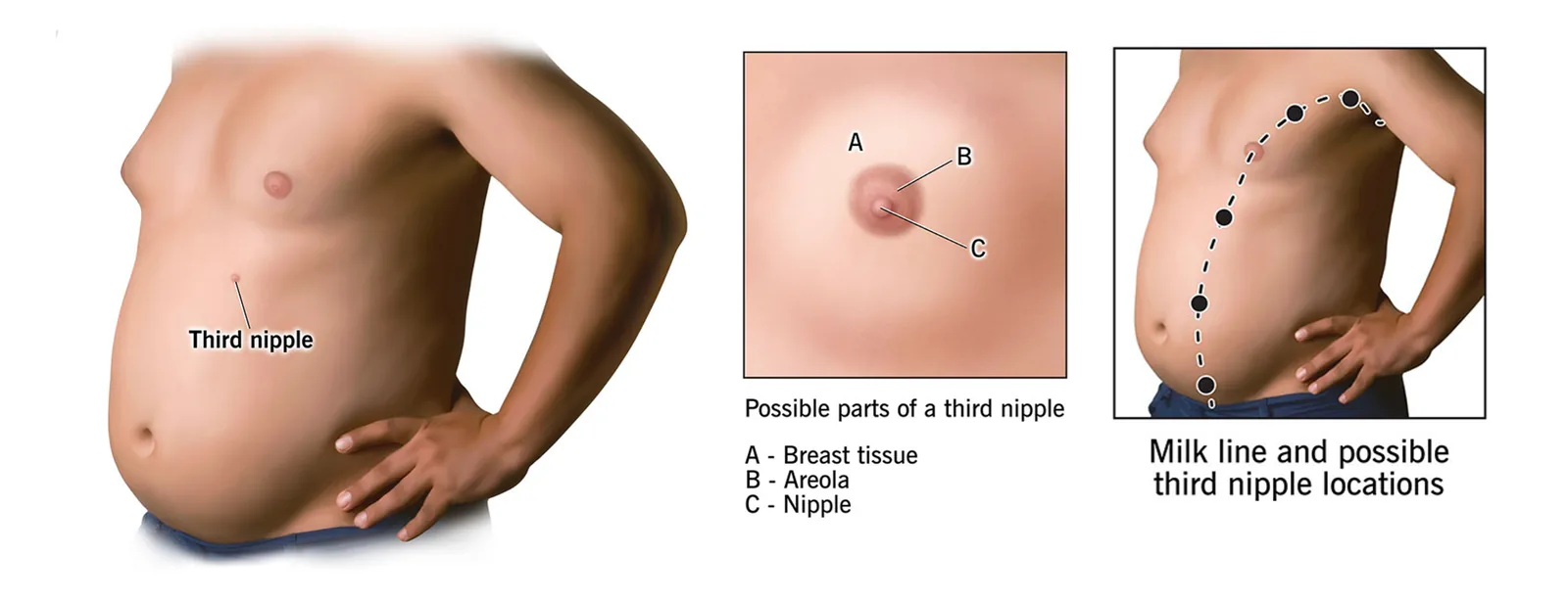 A diagram of the human torso showing the milk line running from the armpit to the groin, with the typical location of supernumerary nipples marked along it.