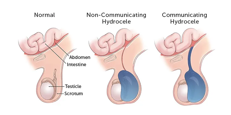 A diagram showing a hydrocele — a buildup of fluid in the sac surrounding the testis — causing visible swelling of the scrotum on the affected side.
