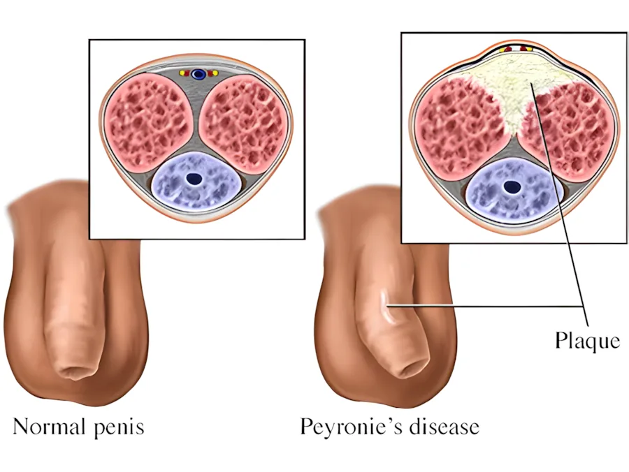 A diagram illustrating Peyronie's disease, showing how scar tissue (plaque) on one side of the penis prevents full expansion during erection, causing an abnormal curve.