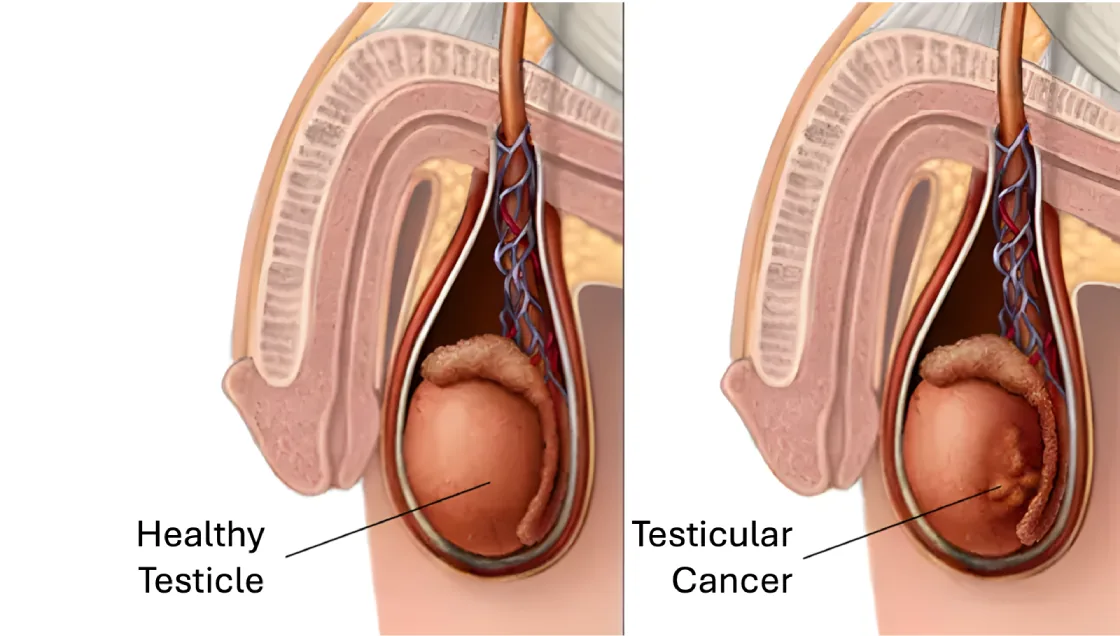 An infographic about testicular cancer showing that it is the most common cancer in men aged 15–29, with a 96% five-year survival rate when caught early, and depicting the typical painless lump as the first warning sign.