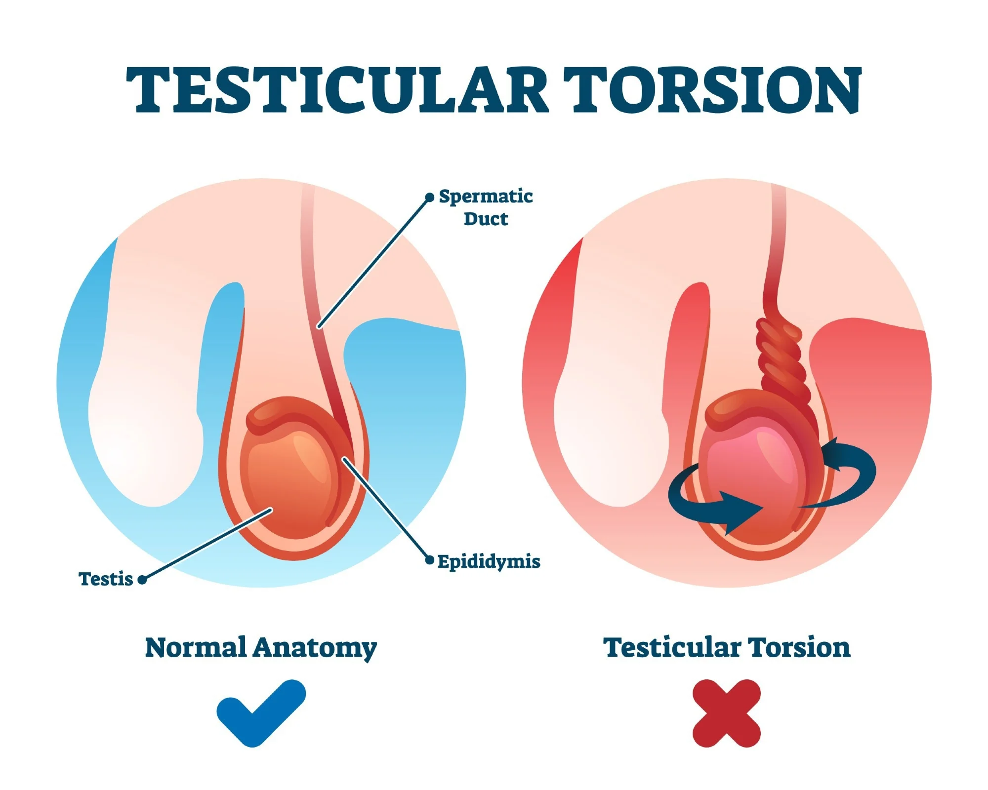 A diagram illustrating testicular torsion, showing the testis twisted on its spermatic cord, cutting off blood flow to the testis.