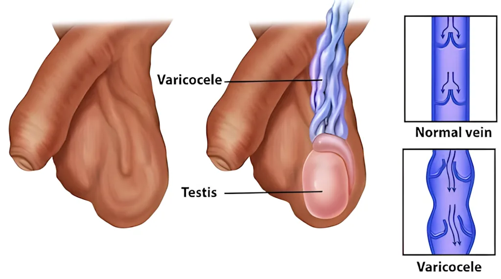 A diagram of a varicocele showing an enlarged, swollen vein in the scrotum above the testis, often described as feeling like a 'bag of worms.'