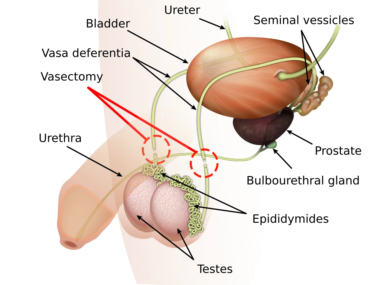 A diagram illustrating the vasectomy procedure, showing the vas deferens being cut and sealed through a small scrotal incision.