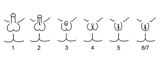 The Quigley Scale, a medical chart depicting a continuum of genital appearance used to classify intersex variations.