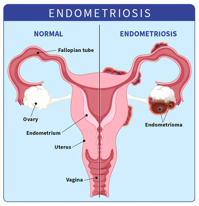 Diagram showing endometrial tissue growing outside the uterus.