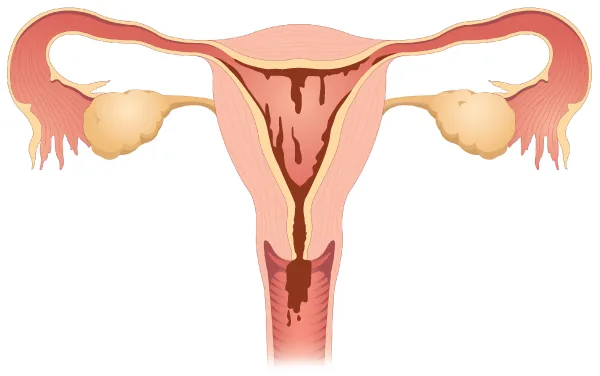 Illustration of menstrual shedding of the uterine lining.