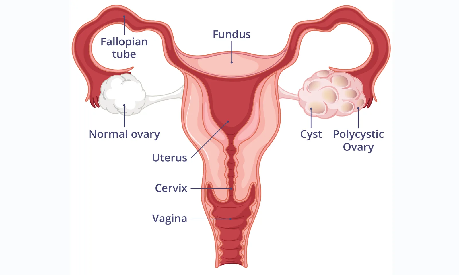 Comparison of normal ovaries and polycystic ovaries.