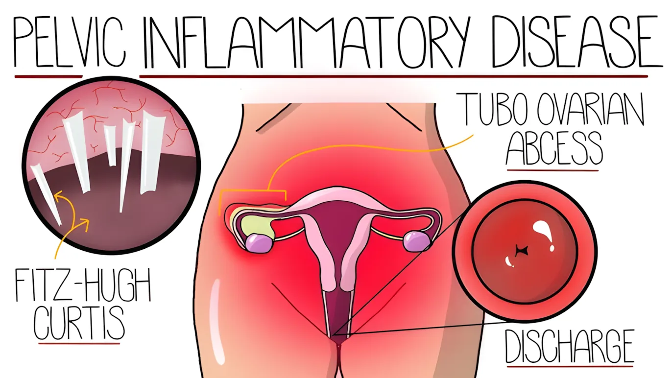 Diagram of pelvic inflammatory disease affecting the reproductive organs.