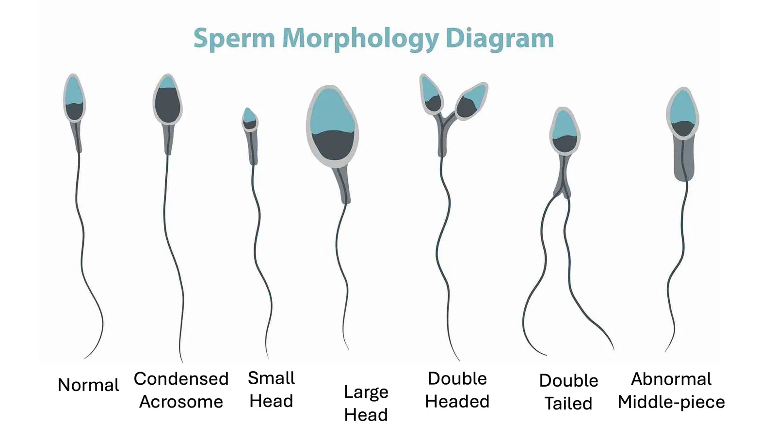 Examples of normal and abnormally shaped sperm.