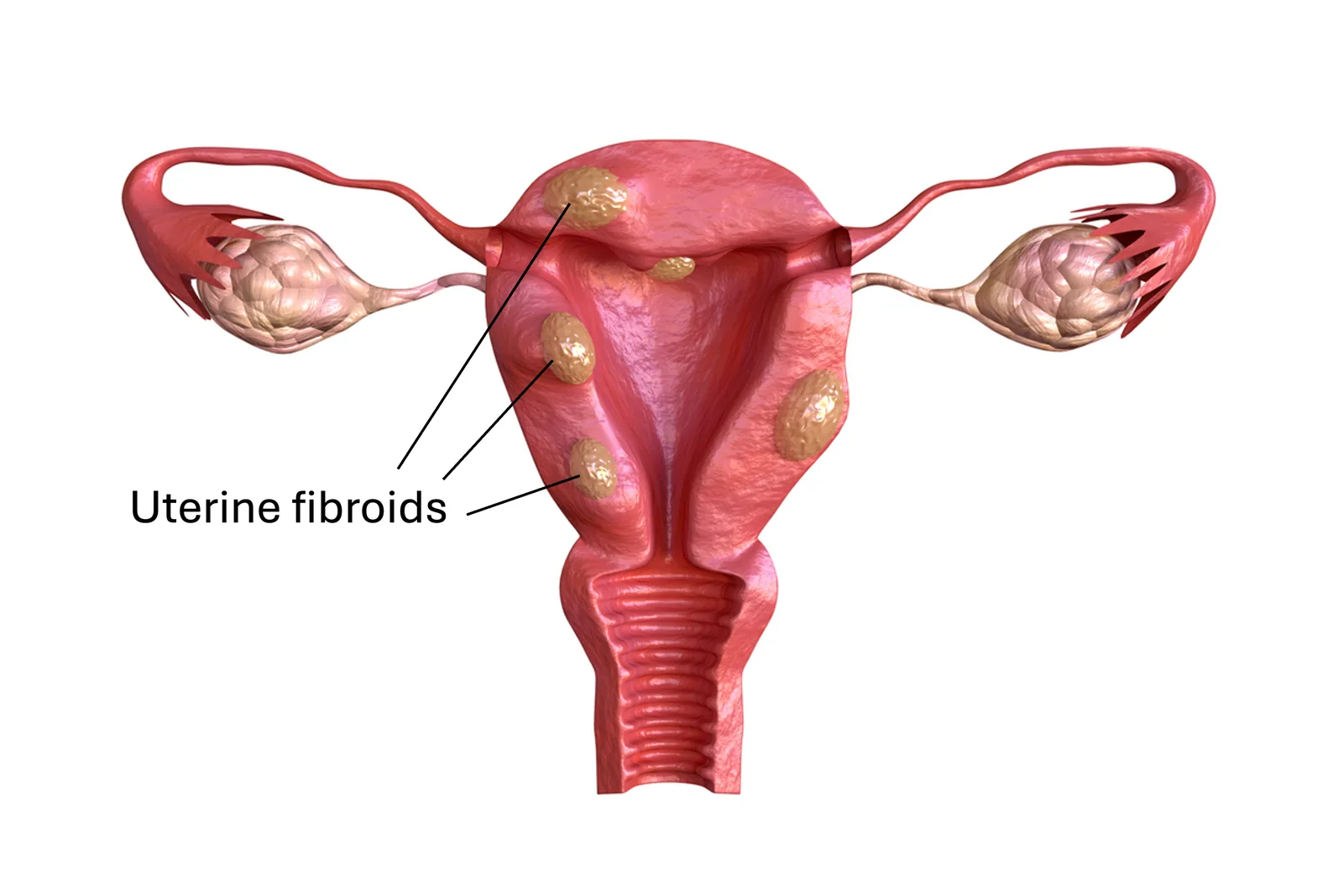 Illustration of uterine fibroids in and around the uterus.