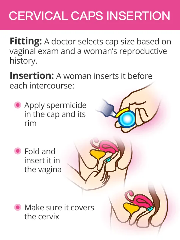Diagram showing how to insert a cervical cap over the cervix.