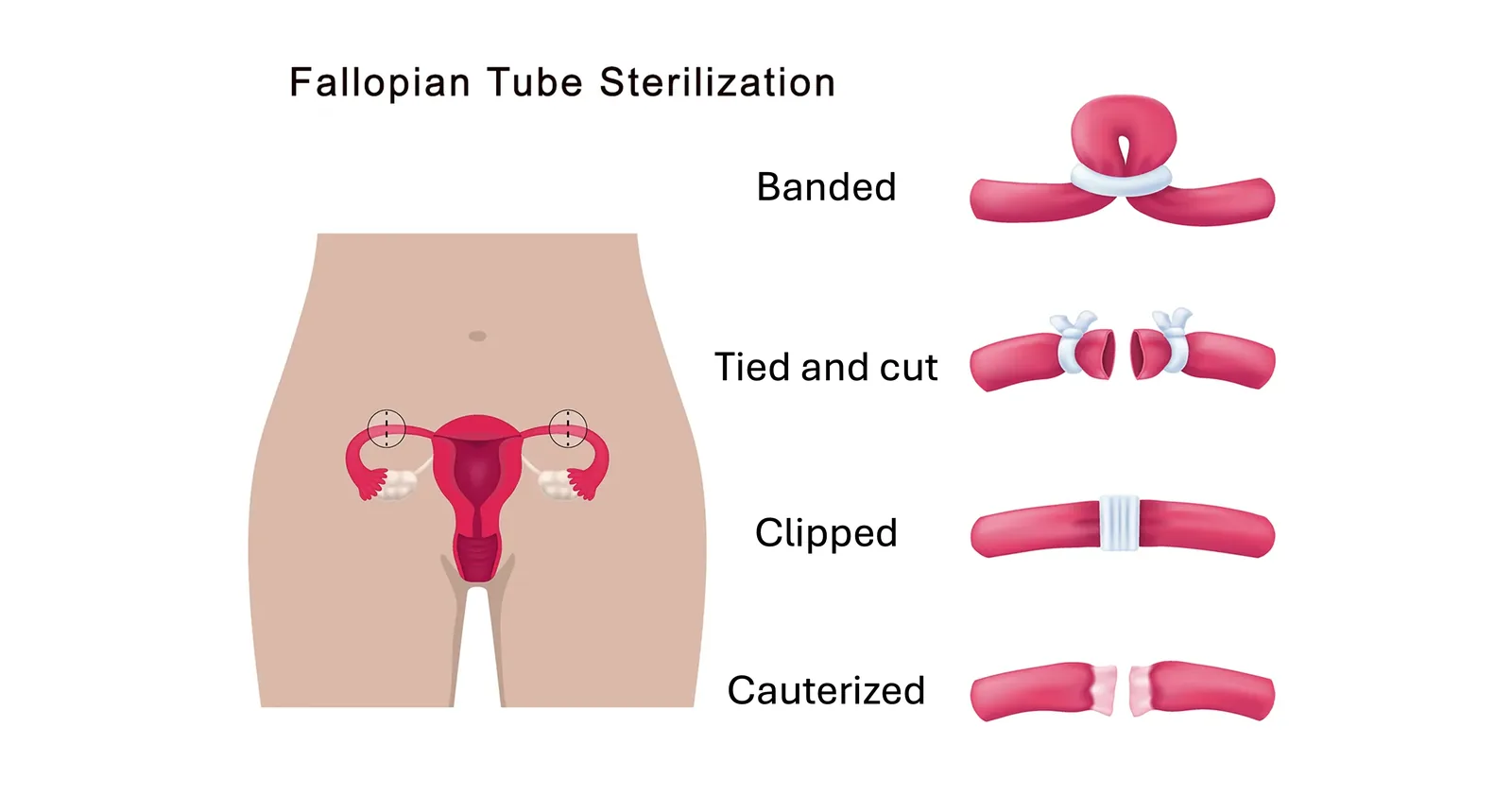 Different methods of tubal ligation on the fallopian tubes.