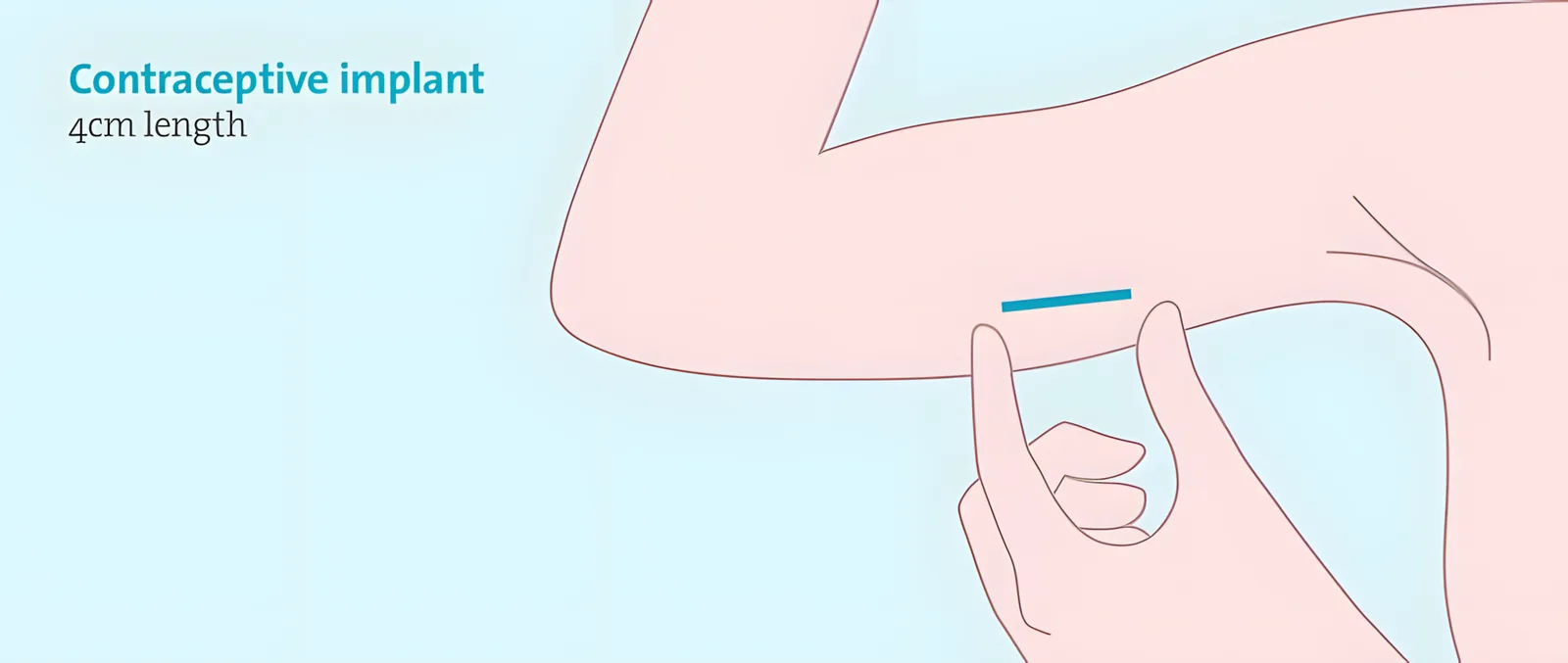 A contraceptive implant being placed under the skin of the upper arm.