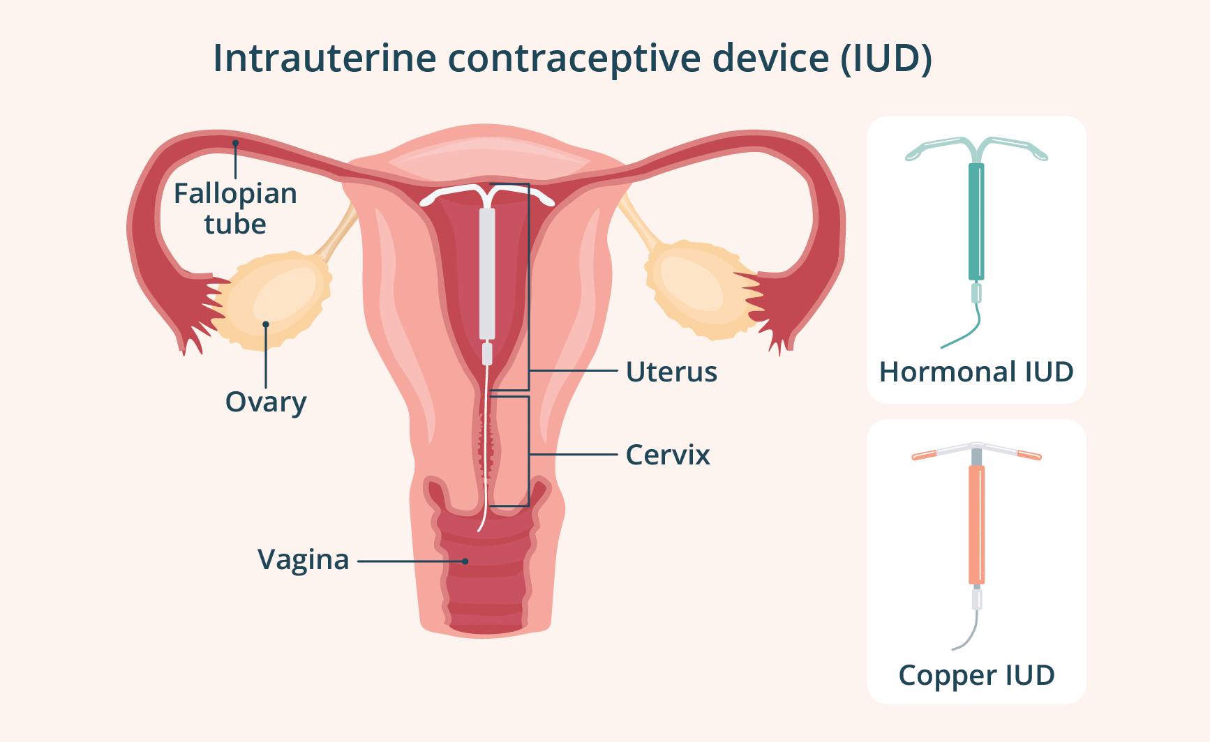 Diagram of an IUD placed inside the uterus with its string through the cervix.