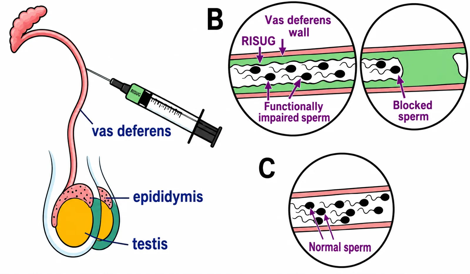 Diagram of RISUG gel injected into the vas deferens to disable sperm.