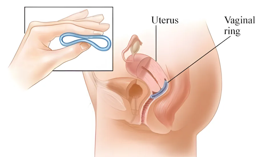 A flexible contraceptive vaginal ring and insertion diagram.