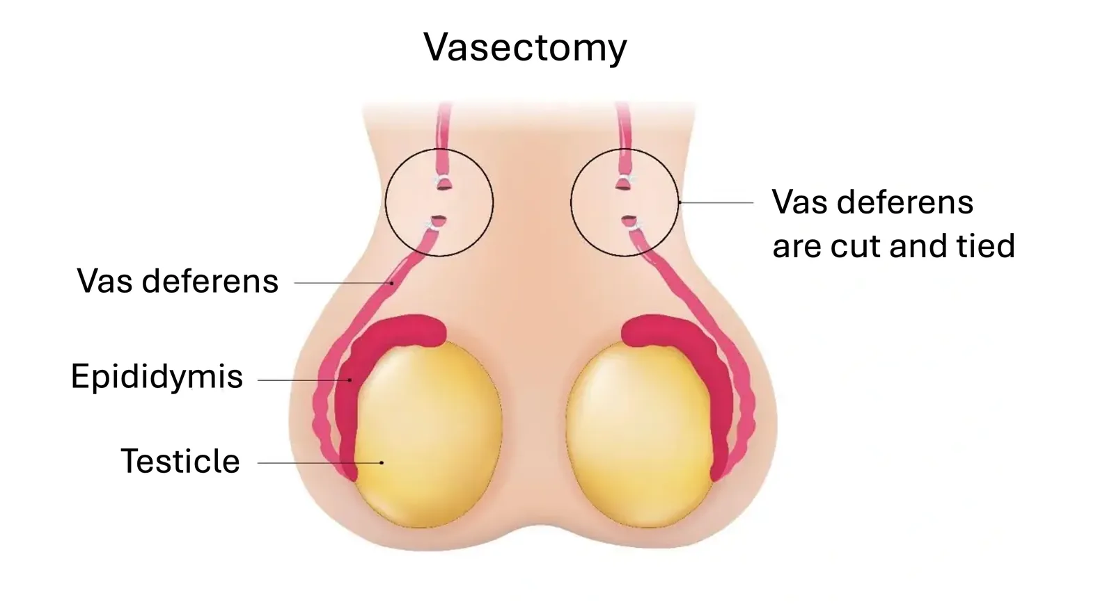 Diagram of a vasectomy cutting the vas deferens.