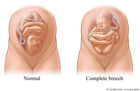 Diagram contrasting a head-down (cephalic) fetal position with a bottom-first breech position.