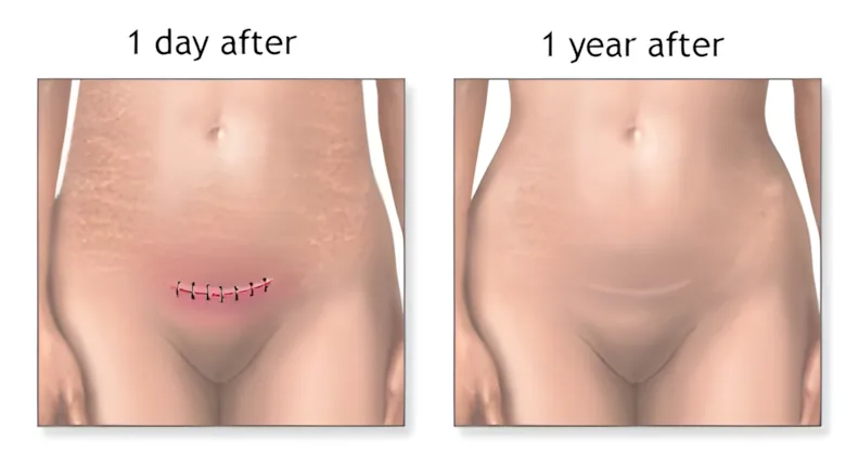 A healed horizontal cesarean section scar on the lower abdomen.