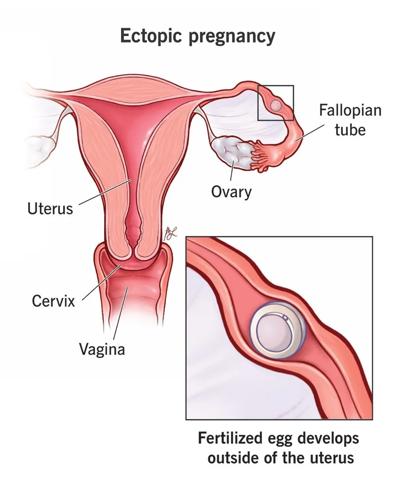 Diagram of an ectopic pregnancy implanted in a fallopian tube rather than the uterus.