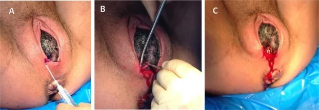 Clinical photograph of an episiotomy incision during delivery.