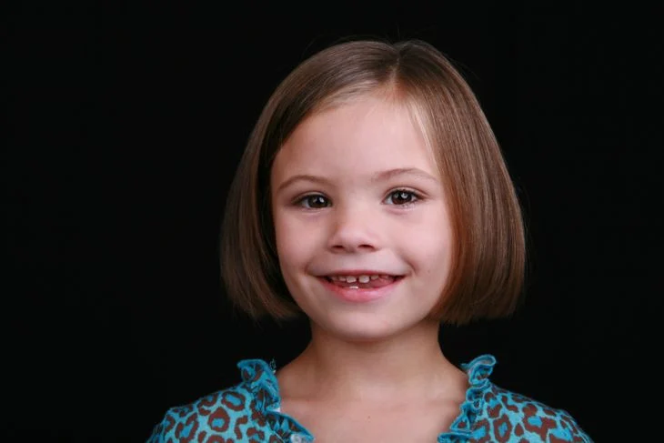 Photograph illustrating the facial characteristics linked to fetal alcohol syndrome.