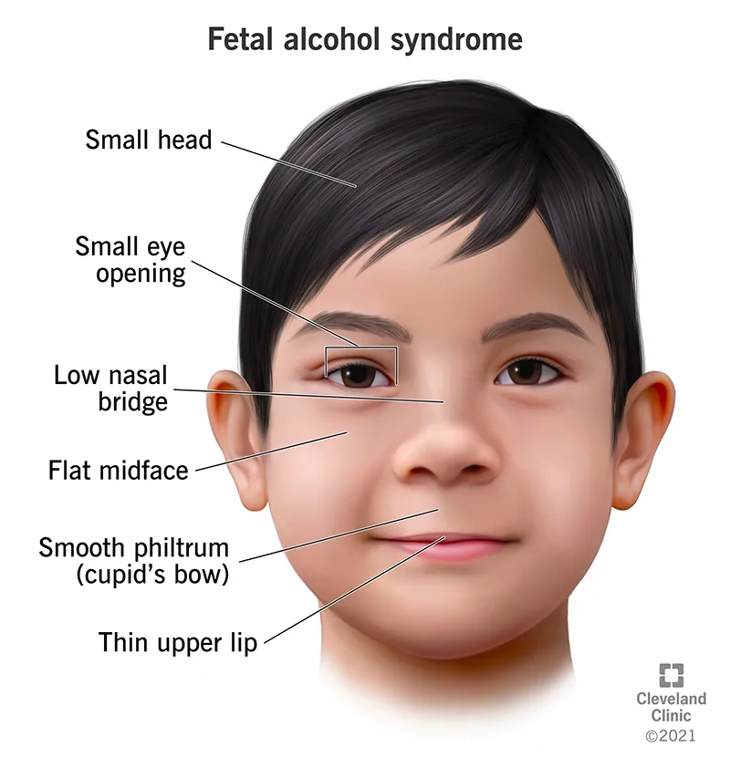 Diagram of the characteristic facial features associated with fetal alcohol syndrome, including a smooth philtrum and thin upper lip.