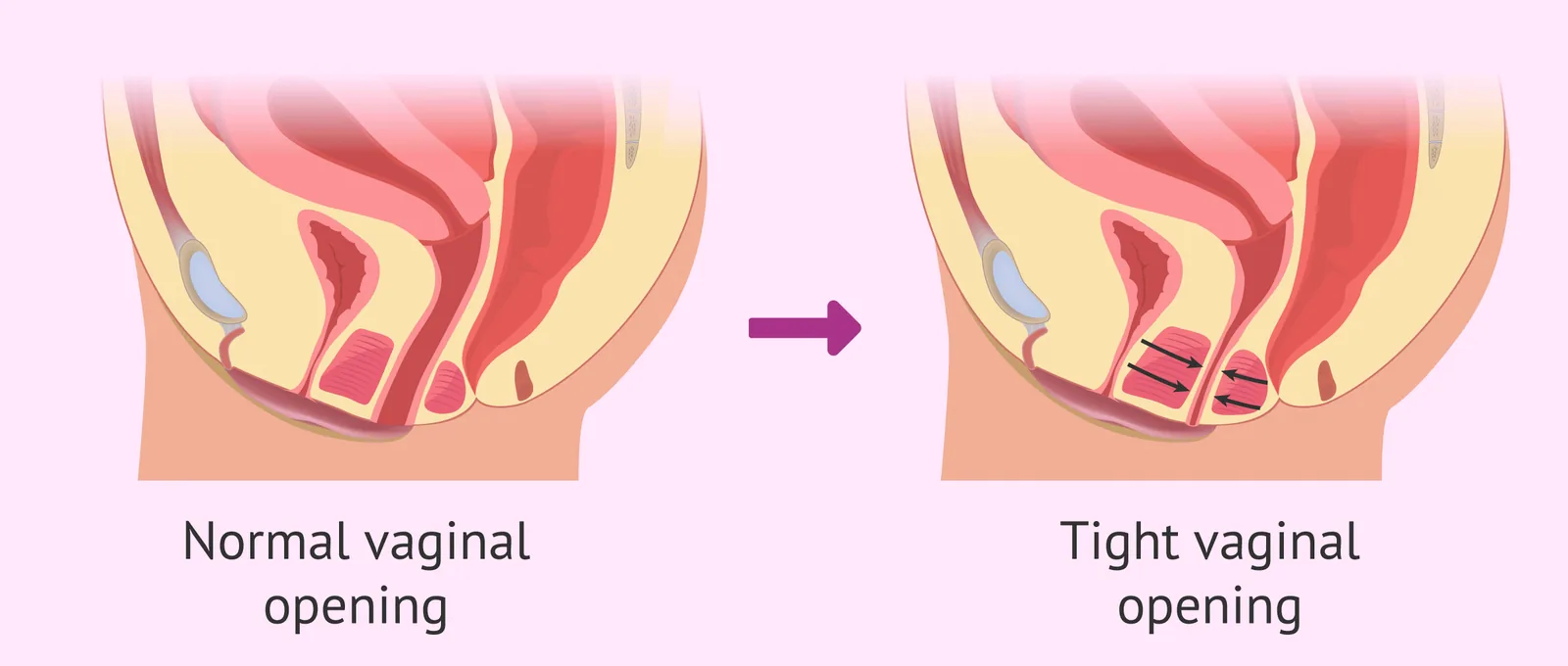 Diagram comparing a relaxed vaginal opening with the involuntary muscle tightening of vaginismus.